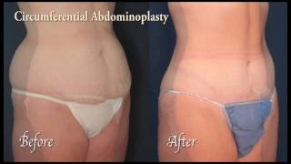 Abdominoplasty: Tummy Tuck Surgery for Baltimore