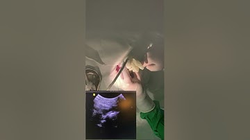 Ultrasound-guided left subclavian central venous catheterisation with microconvex probe.