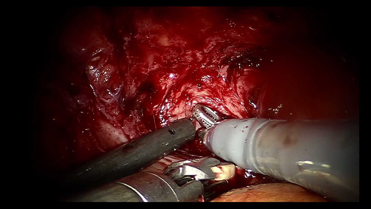 ICS 2021 Abstract #38 Robot-assisted artificial urinary sphincter implantation in female patients with ileal neobladder