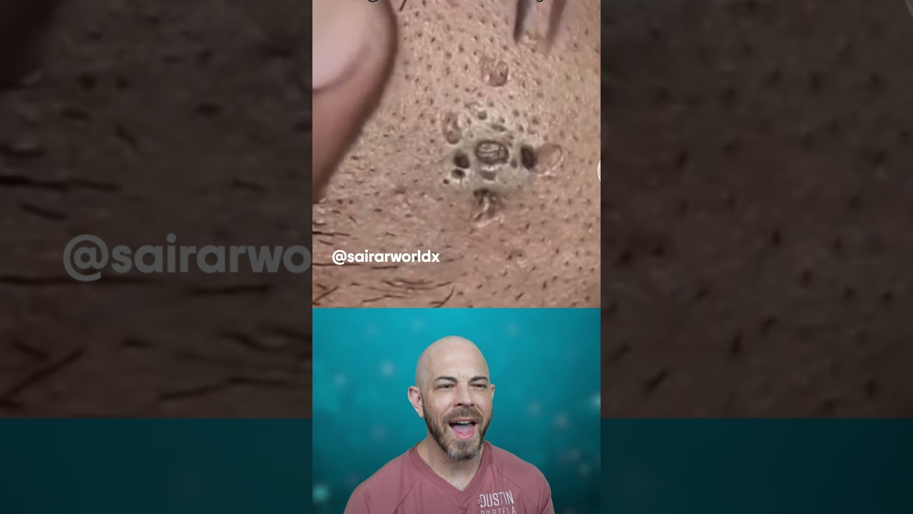 Could this be the longest ingrown hair in all of history?🤯 (credit: @sairarworldx on TT) #ingrown