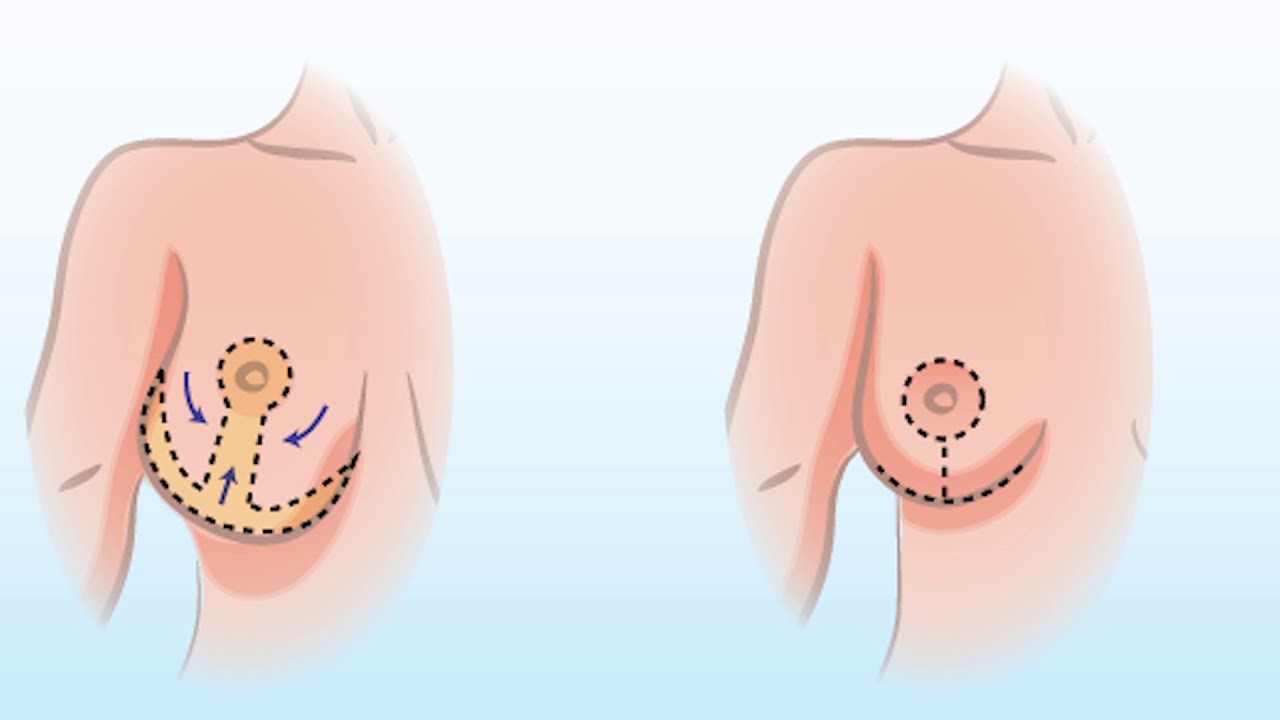 How A Breast Reduction Surgery Works with Dr. Smith