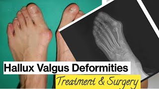 Hallux Valgus Deformity | Bunion Growth | Distal Chevron ...