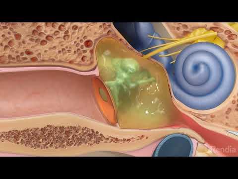 Como Reparar Timpano Perforado