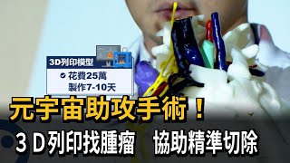 元宇宙助攻手術!3D列印找腫瘤 有助精準切除-民視新聞