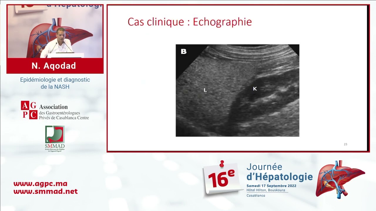 08 epidémiologie et diagnostic de la nash  n  aqodad