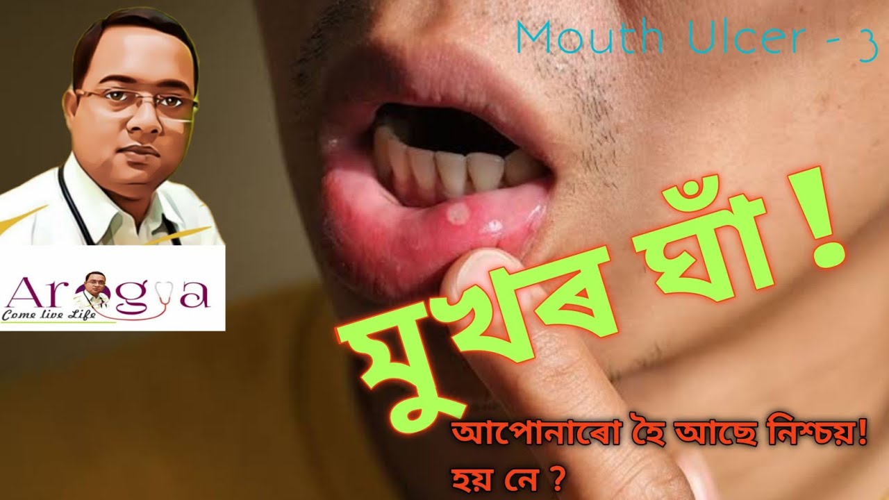 Mouth Ulcer And It s Treatment In Assamese Part 3 How To Prevent mouth-ulcer-and-it-s-treatment-in-assamese-part-3-how-to-prevent