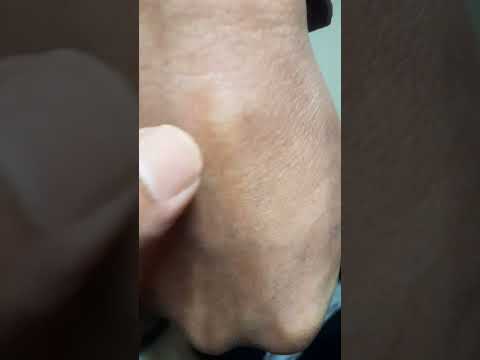 ظهور النتوء العظمي في اليدين الاثنين بشكل واضح