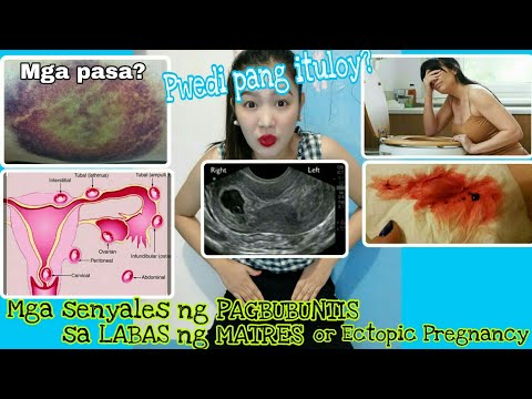 SIGNS AND SYMPTOMS OF ECTOPIC PREGNANCY | (TAGALOG)