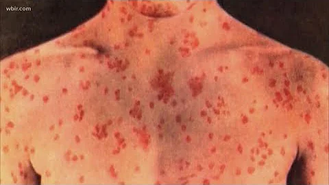 Two more measles cases reported in East Tennessee