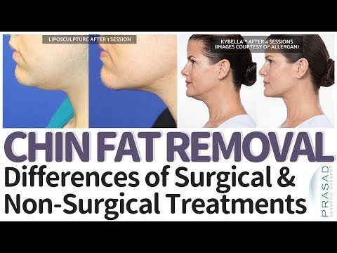 Double Chin Treatment - Pros and Cons of Surgical and Non-Surgical Solutions