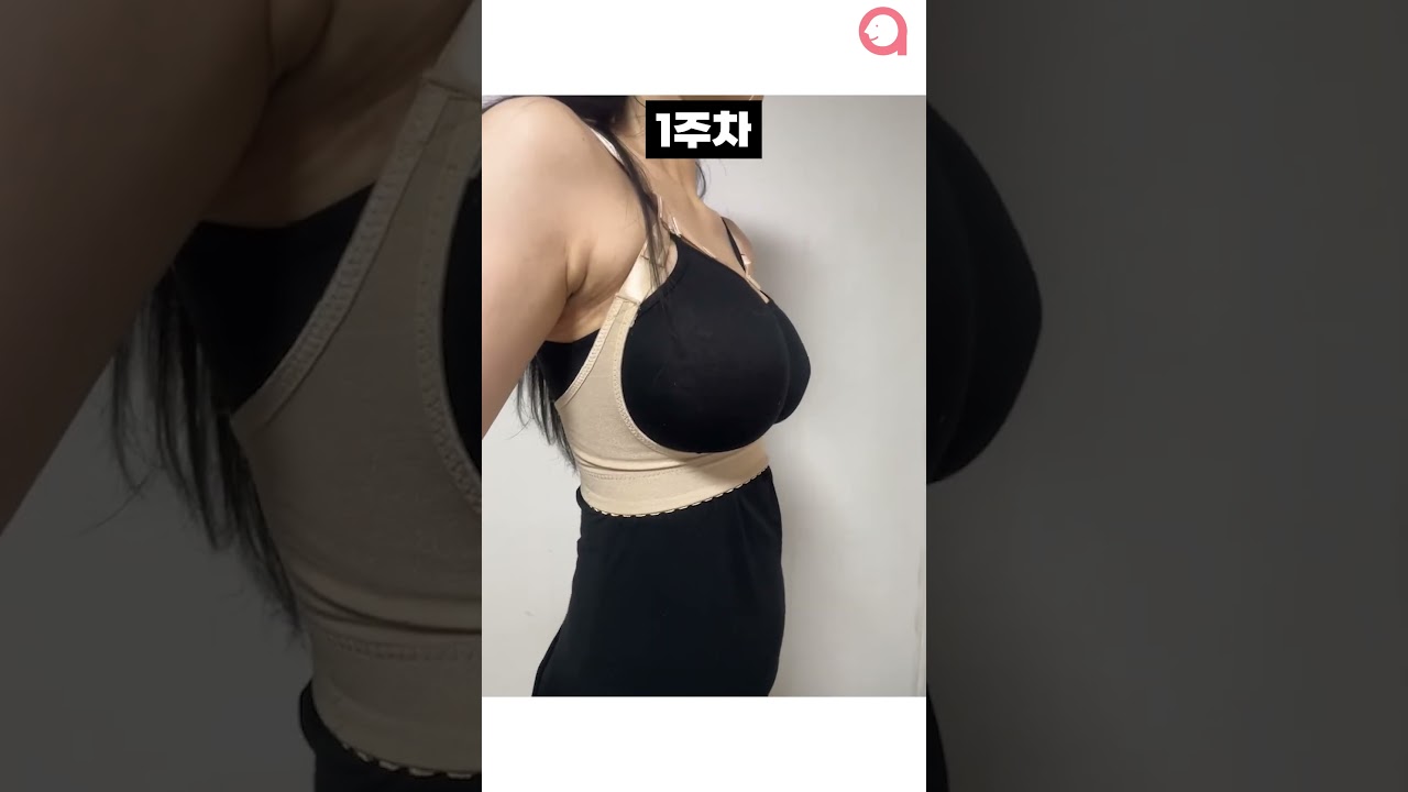 [Эй Топ гоо сайхны мэс заслын эмнэлэг] Орчин үед хөх томруулах мэс засал хийсэн нь мэдэгдэхгүй болсон, үнэхээр! #shorts