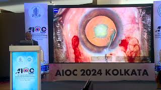 AIOC2024  IC273 Topic  Dr J  S  Titiyal In Posterior Polar Cataract when I am not supposed to rotate