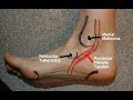 Posterior Tibial Tendinitis Evaluation with Paul Marquis PT