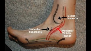 Posterior Tibial Tendinitis Evaluation with Paul Marquis PT