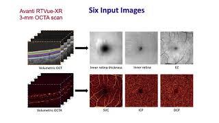Deep-learning-aided detection of referable and vision threatening diabetic retinopathy based on