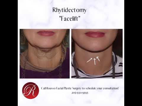 Facelift - YouTube