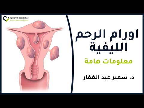 هل الورم الليفي في الرحم ورم خبيث أم ورم حميد