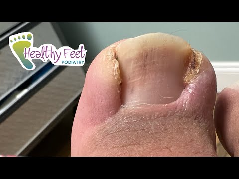 ENORMOUS TOE CAUSED BY AN INGROWN NAIL