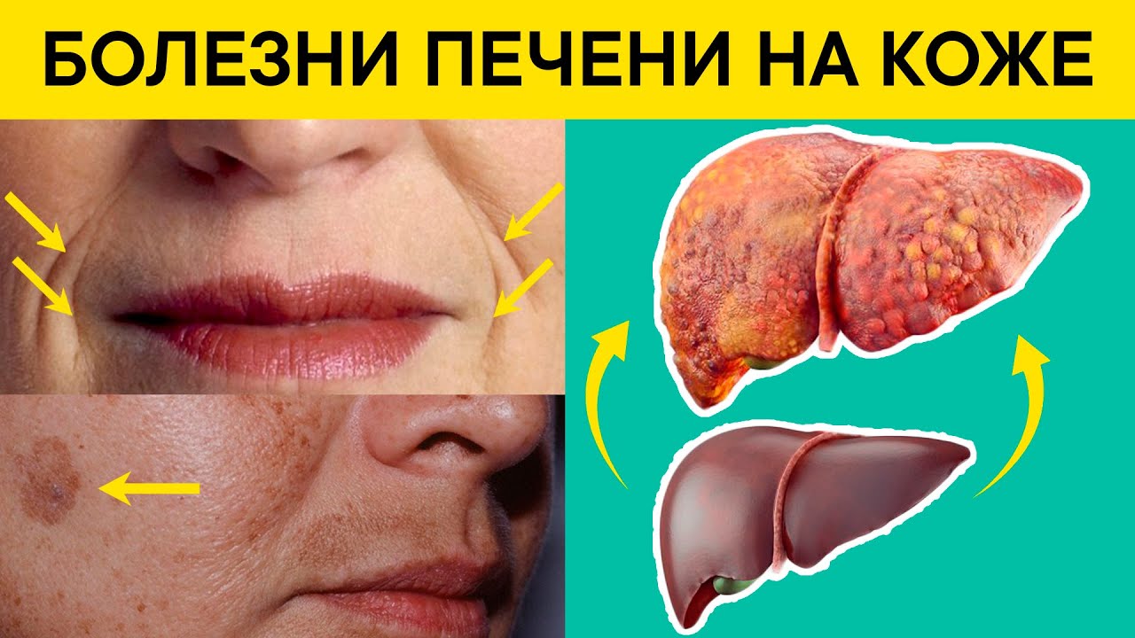 Как обнаружить БОЛЕЗНИ ПЕЧЕНИ по признакам НА КОЖЕ? Проверьте свою кожу ...