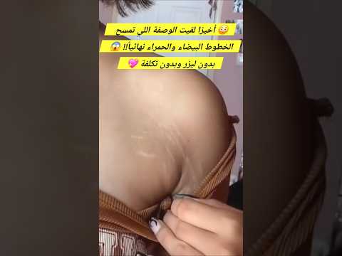 الوصفة السحرية لي خلصتني من الخطوط البيضاء والحمراء ود عت علامات التمدد والترهلات نهائيا 