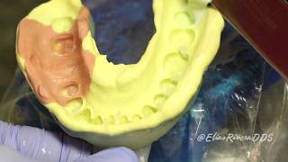 Fabricating Working Cast and Dies - Preclinical Fixed Prosthodontics