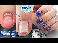 NAIL TORN OFF Part 2 -Restoration | Cat's Eye Effect & Dual Forms