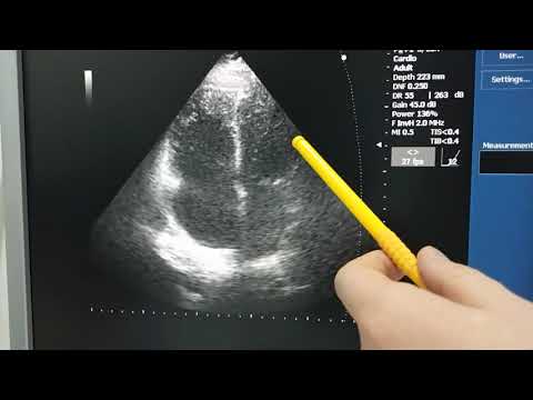 Видео: Тромбоэмболия легочной артерии после операции: знайте риски