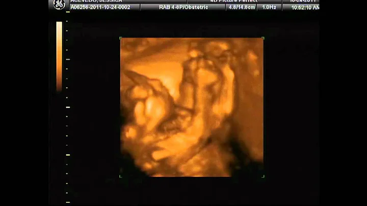 Jackson Phillip Acevedo 3D ultrasound
