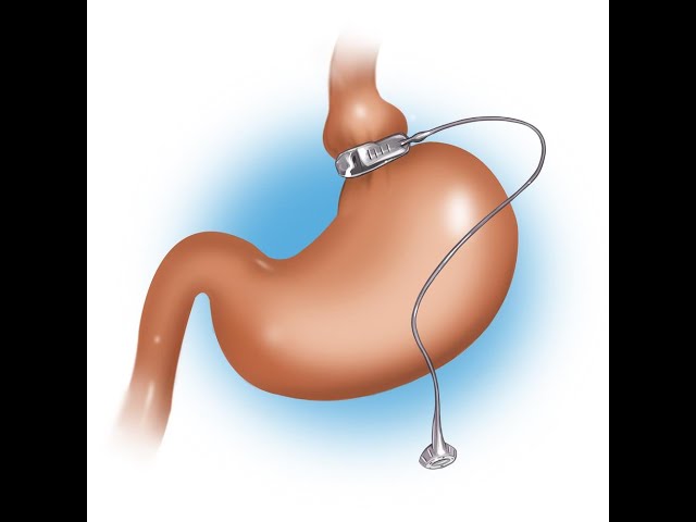 The Virtual Gastric Band