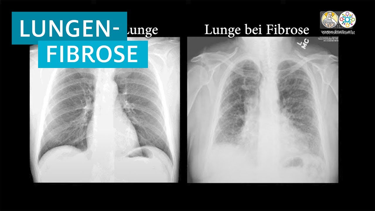 Idiopathische Lungenfibrose (Deutsch)