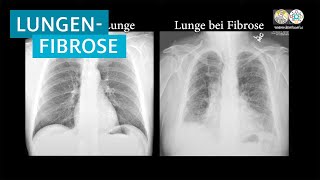 Lungenfibrose