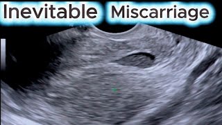 Inevitable Miscarriage - A Miscarriage that has started !!