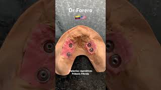 Implantes Cigomáticos Con Prótesis Híbrida. Dr Forero. Ña