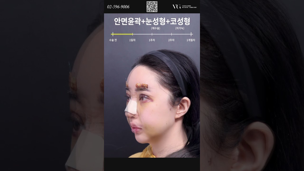 [貝利古德整形外科診所] #短片 #貝利古德TV 面部輪廓+二次眼部手術+隆鼻手術(自體肋軟骨) 從術前到真實術後心得✔