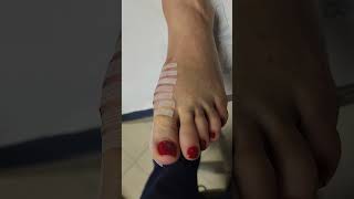 23 Y.o. Gets Bunion Surgery, Now Just 5 Days Later...