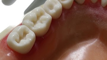 #19 Occlusal Amalgam Prep - Dr. James Keddington (UofU SOD)