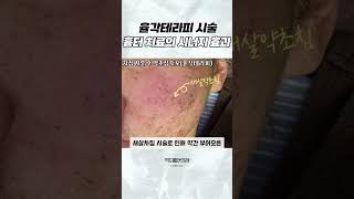 율각테라피 시술, 흉터치료의 시너지 효과✨ #shorts