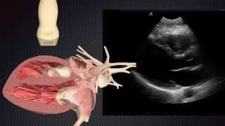 Basic Cardiac Ultrasound Views 1:   Parasternal Long Axis (PSLA)