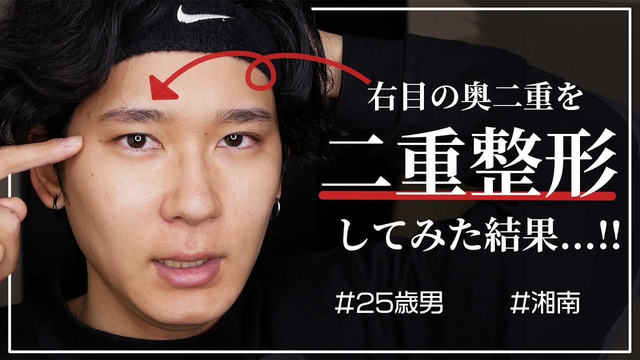 二重整形 奥二重の男が埋没してみた 湘南 スクエア二重術 Youtube 二重整形 奥二重の男が埋没してみた 湘南 スクエア二重術 Youtube