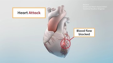 Heart attack vs. cardiac arrest: What