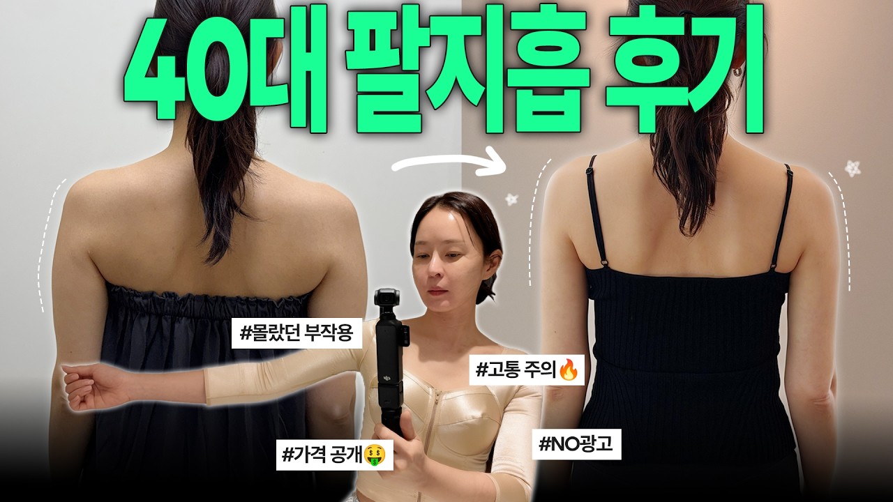 [Vlog]내돈내산🤑40대의 리얼한 팔뚝지방흡입 한달반 후기✨수술 고통, 만족도, 사후관리까지|팔지흡 만족? 팔지흡 부작용?