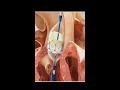 Transcatheter aortic valve implantation (TAVI) #science #shorts #anatomy