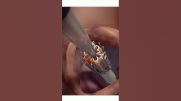 Transcatheter aortic valve implantation (TAVI) #science #shorts #anatomy