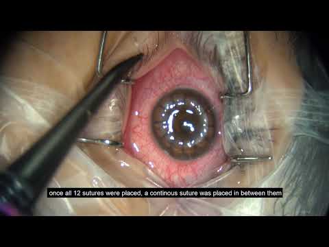 Corneal transplant surgery