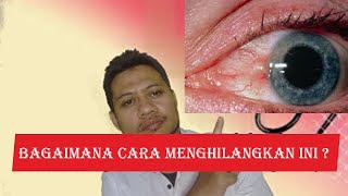 BAGAIMANA MENGHILANGKAN BINTIK KUNING DI BAGIAN PUTIH MATA?