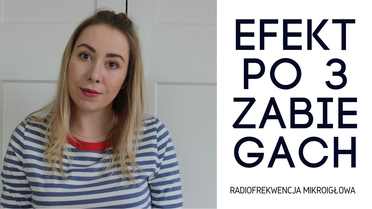 Radiofrekwencja mikroigłowa efekty po 3 zabiegach + zniżka dla WAS