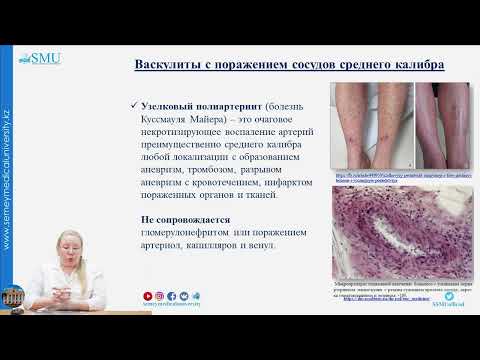 Системные васкулиты