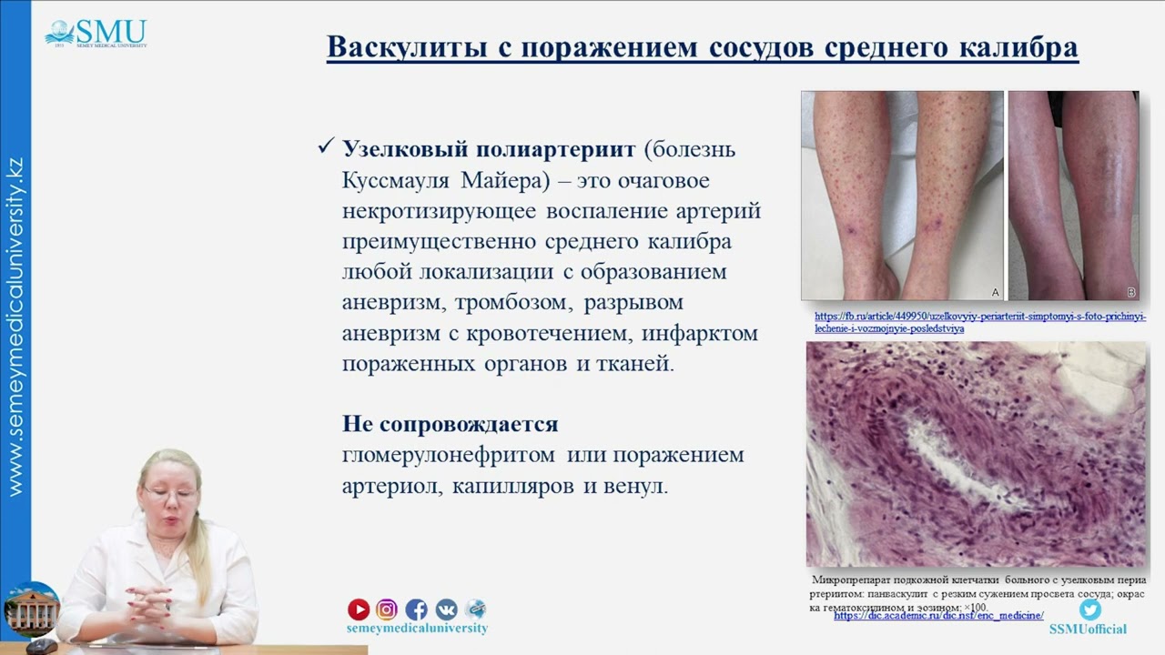 Системные васкулиты