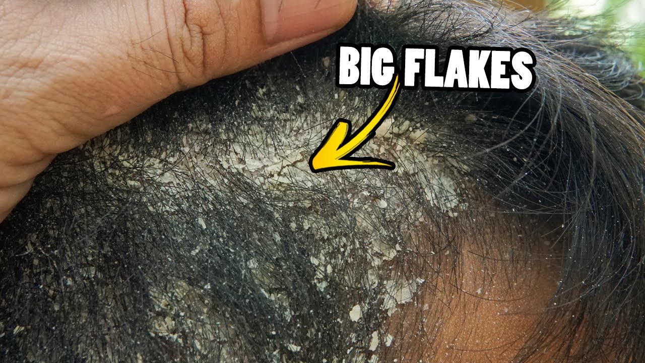 Dandruff flakes REMOVAL!! Satisfying Scalp Scratching And Picking Big