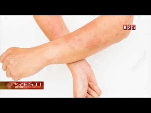 Video: Kontaktni Dermatitis: Uzroci, Simptomi I Liječenje